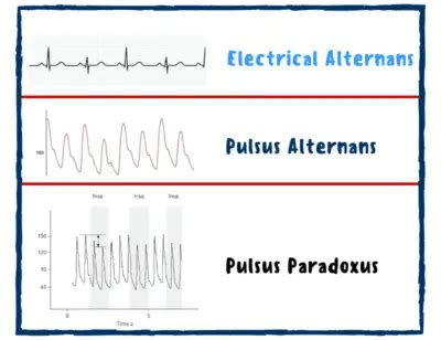 what is pulsus alternans.